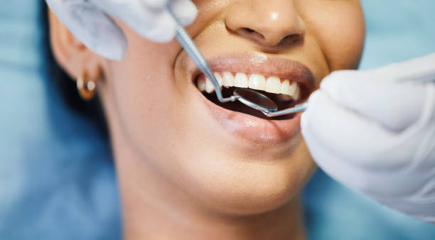 Best Emergency Wisdom Tooth Extraction in USA